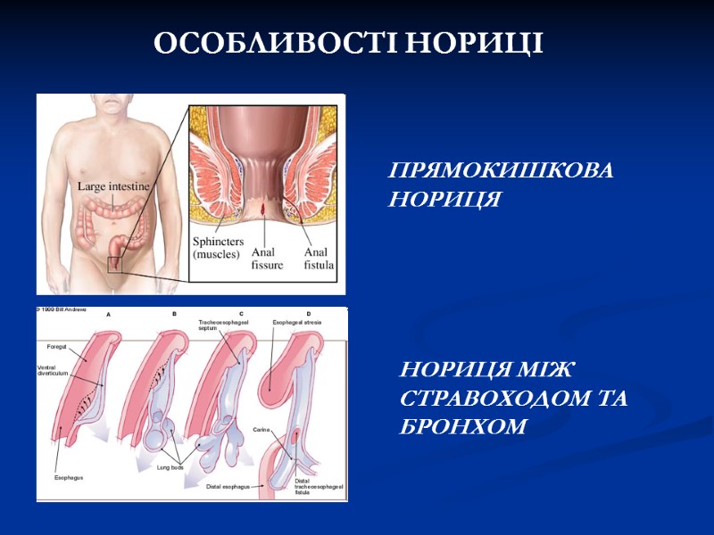ОСОБЛИВОСТІ НОРИЦІ ПРЯМОКИШКОВА НОРИЦЯ НОРИЦЯ МІЖ СТРАВОХОДОМ ТА БРОНХОМ ОСОБЛИВОСТІ НОРИЦІ ПРЯМОКИШКОВА НОРИЦЯ НОРИЦЯ МІЖ СТРАВОХОДОМ ТА БРОНХОМ